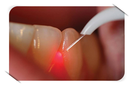 Laser Treatment